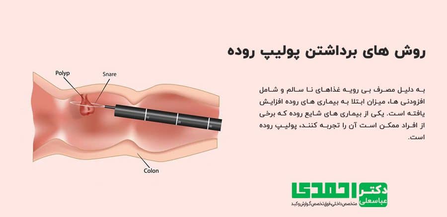 فیلم عمل /جراحی کولونوسکوپی
