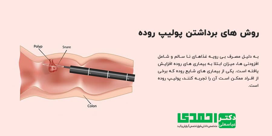 فیلم جراحی لاپاراسکوپی روده بزرگ
