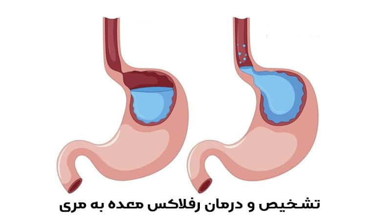 تشخیص و درمان رفلاکس معده به مری - دکتر عباسعلی احمدی
